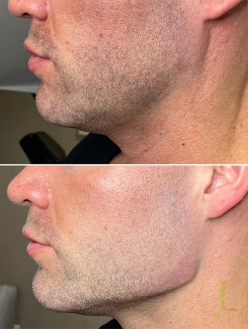 زاویه سازی فک و چانه